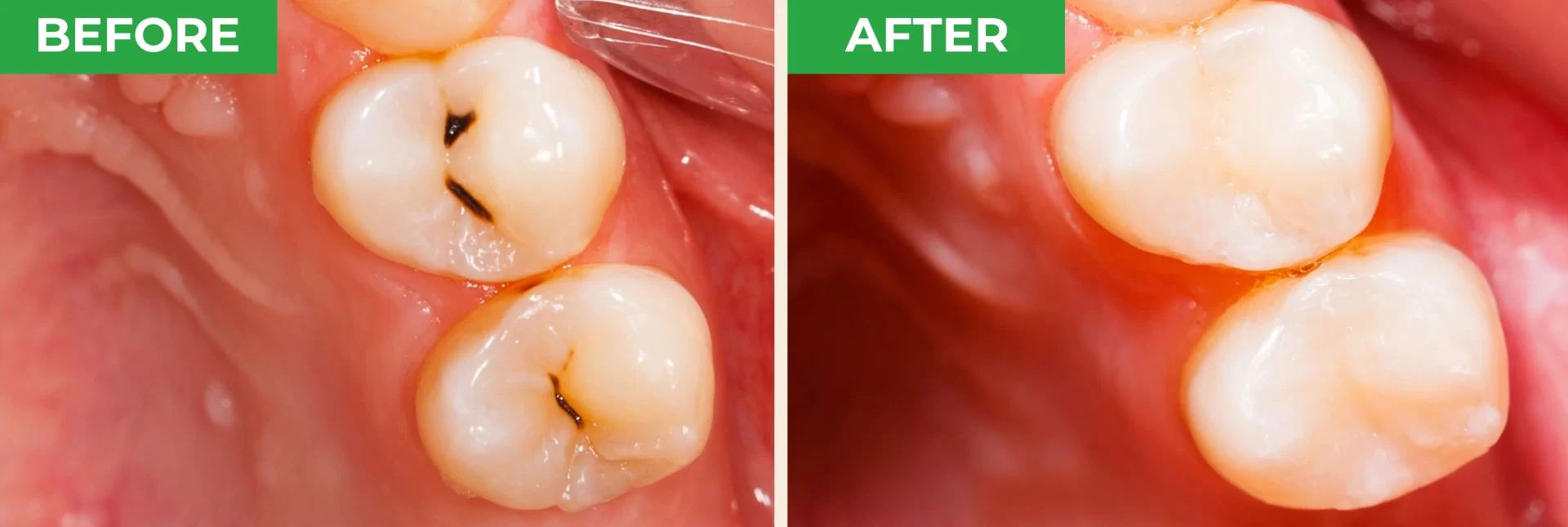 ProXental-Before-and-After